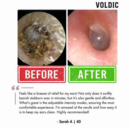 Electric Ear Wax Removal Kit